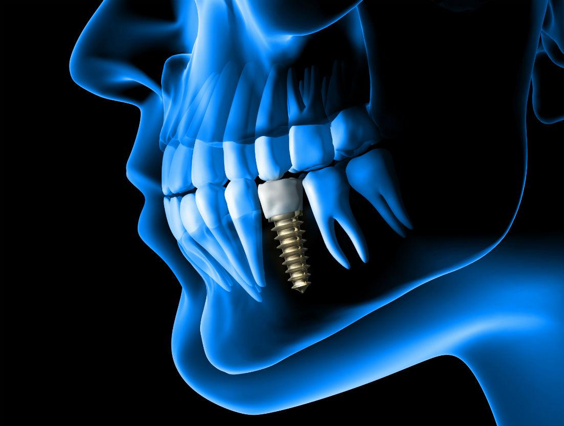 Dental Implants San Antonio, TX